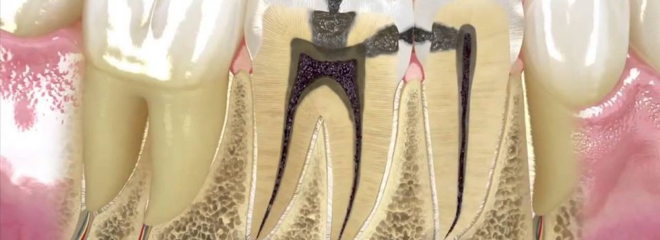 Endodonti, Kanal Tedavisi